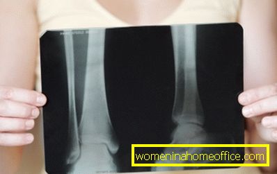Behandling av osteoporose hos kvinner