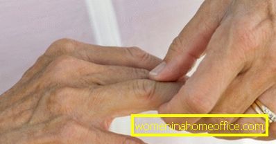 Rheumatoid artritt av fingrene: de første symptomene